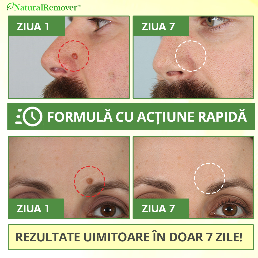 NaturalRemover™ Dispozitiv Îndepartare Veruci